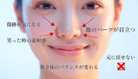 小鼻縮小だけのデメリット