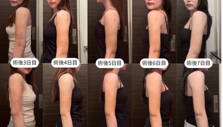 脂肪吸引後のダウンタイムの主な症状と期間