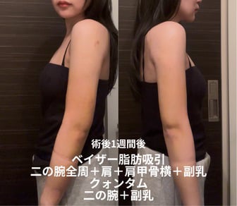 二の腕の脂肪吸引｜ダウンタイムを短くする脂肪吸引エキスパートドクター小野聡真医師の工夫