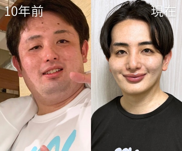 私は脂肪吸引を受けて、本当に良かったと思っています