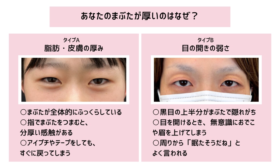 あなたの重いまぶたタイプ別セルフチェック