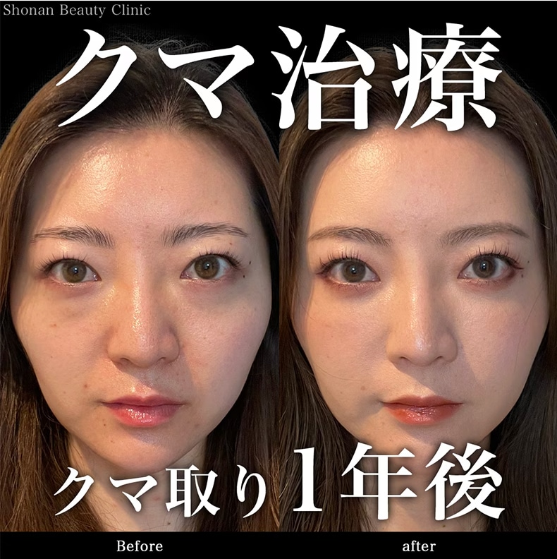 術後1年後のリアルな気持ちとは？