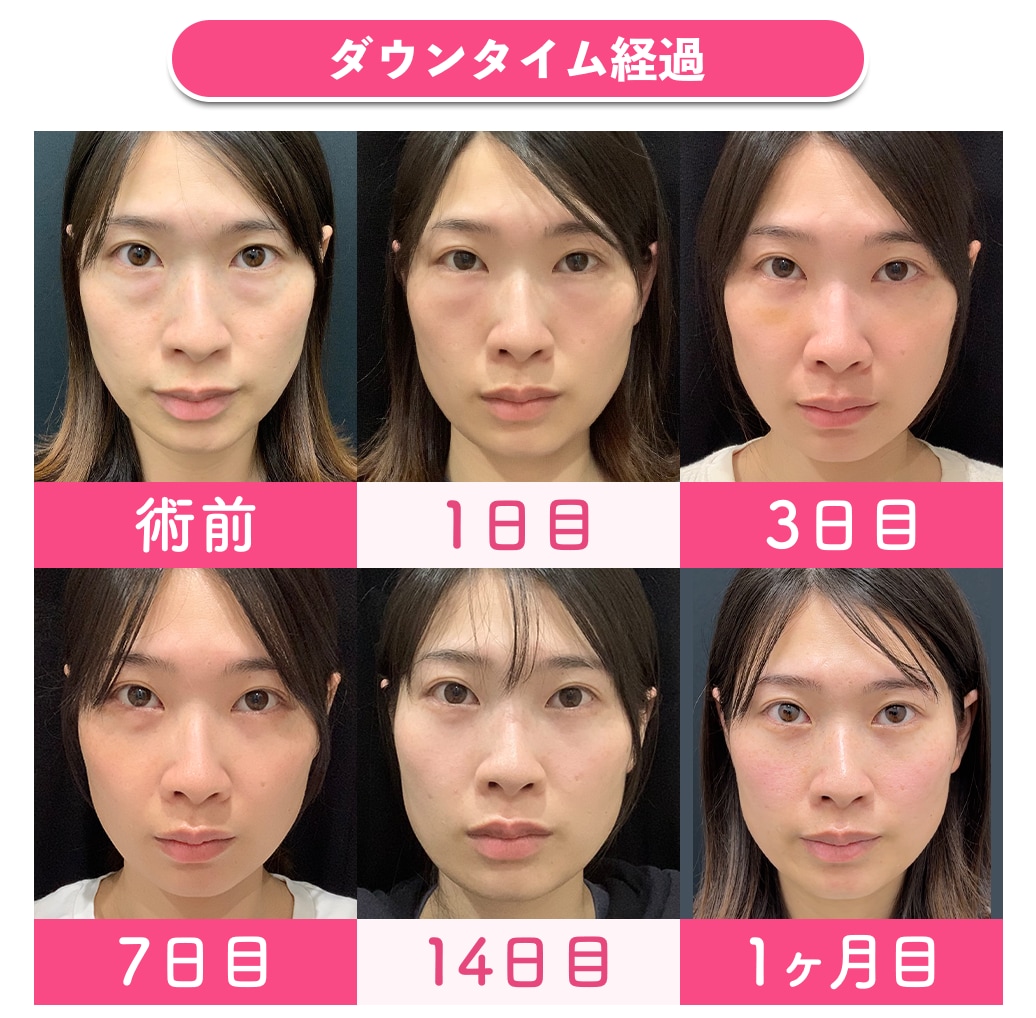 クマ取りのダウンタイムはどれくらい？