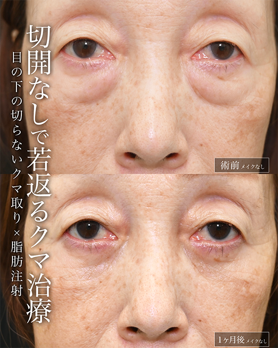 切開レベルでも切らずに治療