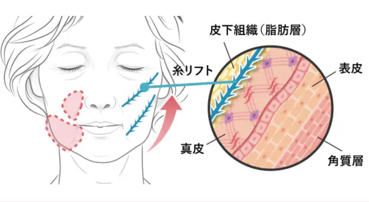 糸リフトとはどんな治療？