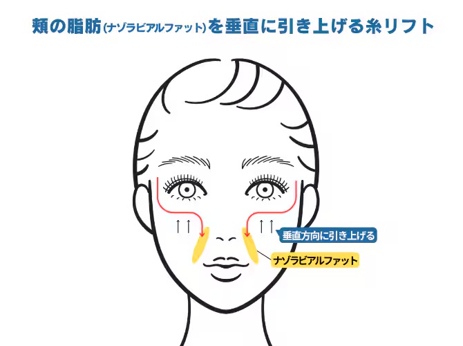 バーティカルリフトについて