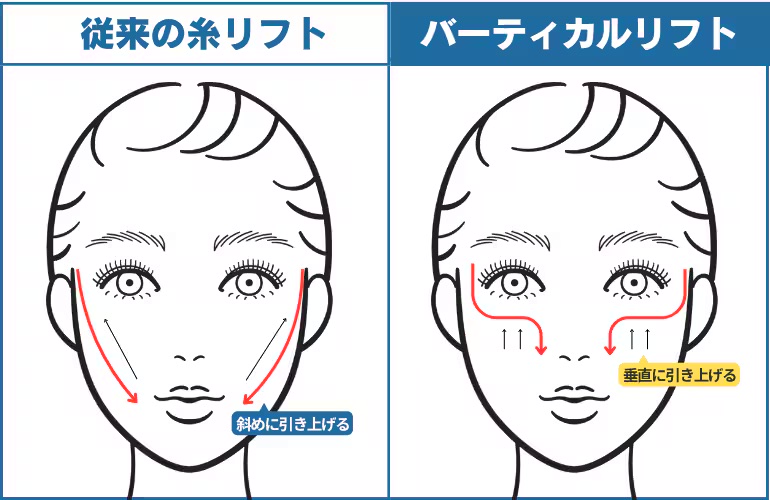 一般的な糸リフトとの違い