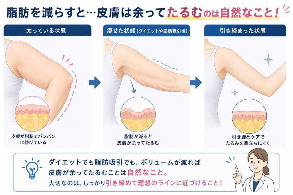 脂肪吸引でボリュームが減ることで、それまで脂肪を覆っていた皮膚が余り、たるみが目立つ場合があります。