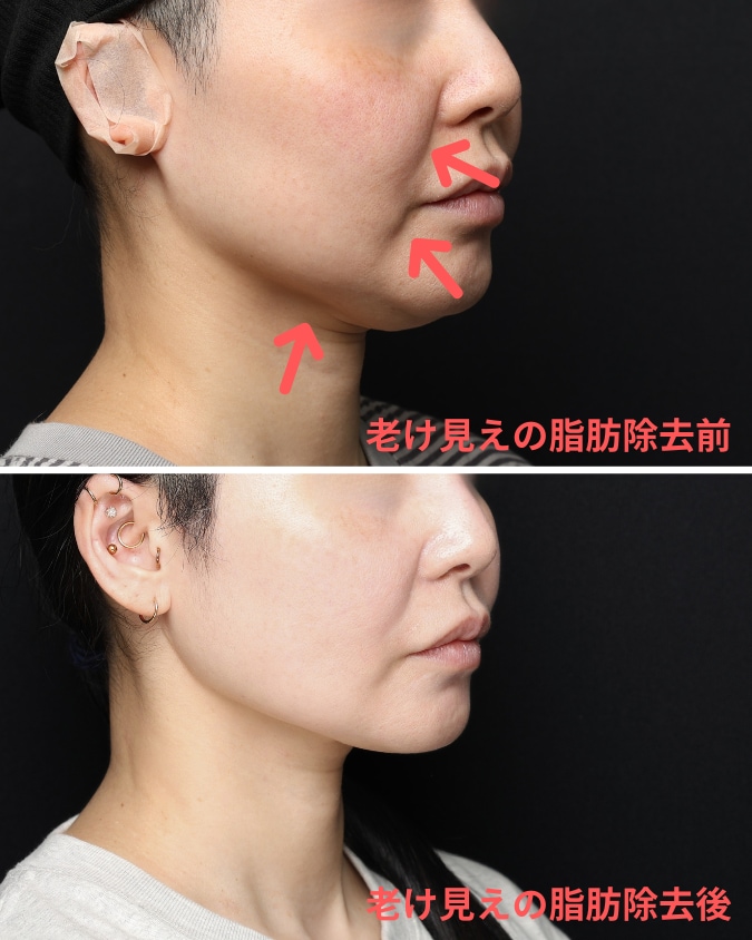 顔の脂肪には、「若く見える脂肪」と「老けて見える脂肪」があります。