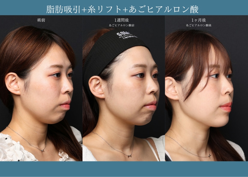 口ゴボには脂肪吸引にあごヒアルロン酸を組み合わせるのが最強⁉︎脂肪吸引エキスパートドクター小野聡真が解説