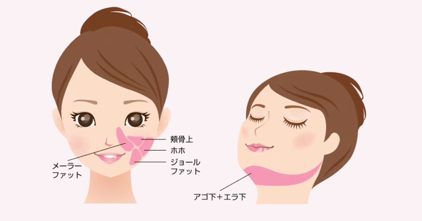 顎下・口元のもたつきに顔の脂肪吸引