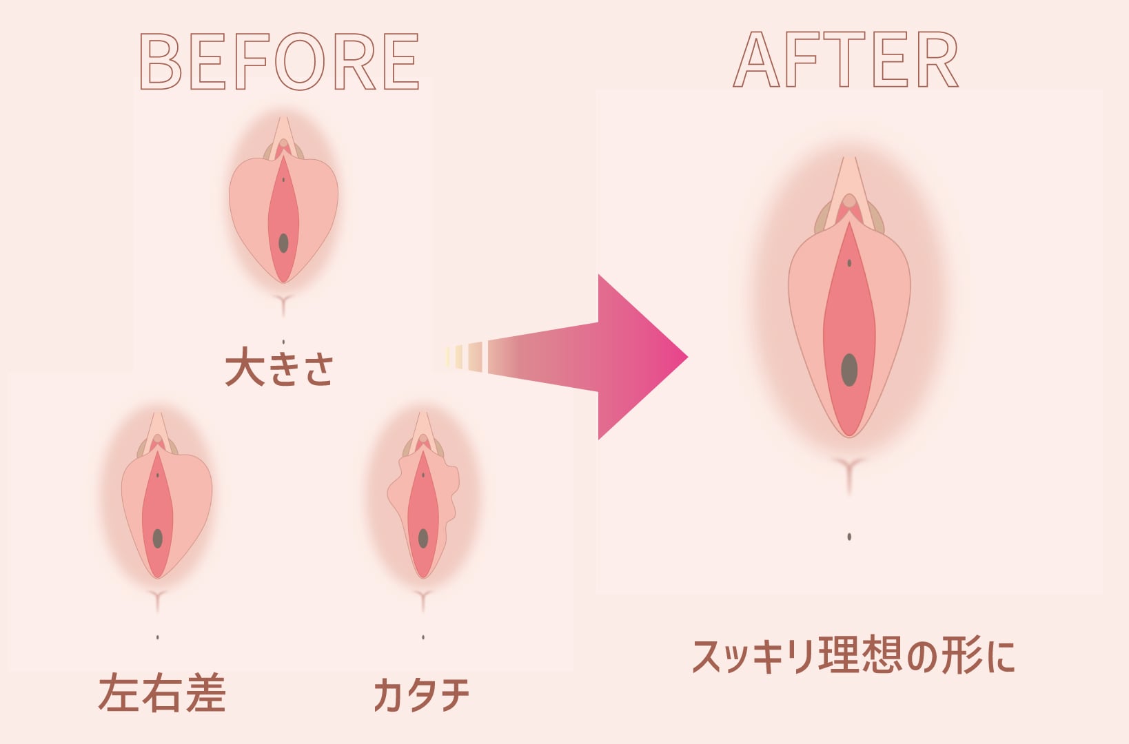 小陰唇縮小術における抜糸あり・なしの違いとは