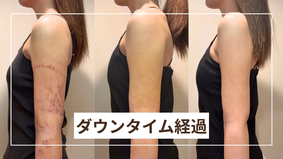 【二の腕脂肪吸引のダウンタイム経過14日間公開】脂肪吸引エキスパートドクター小野医師の脂肪吸引を受けた30代看護師の仕事復帰までのリアルな経過