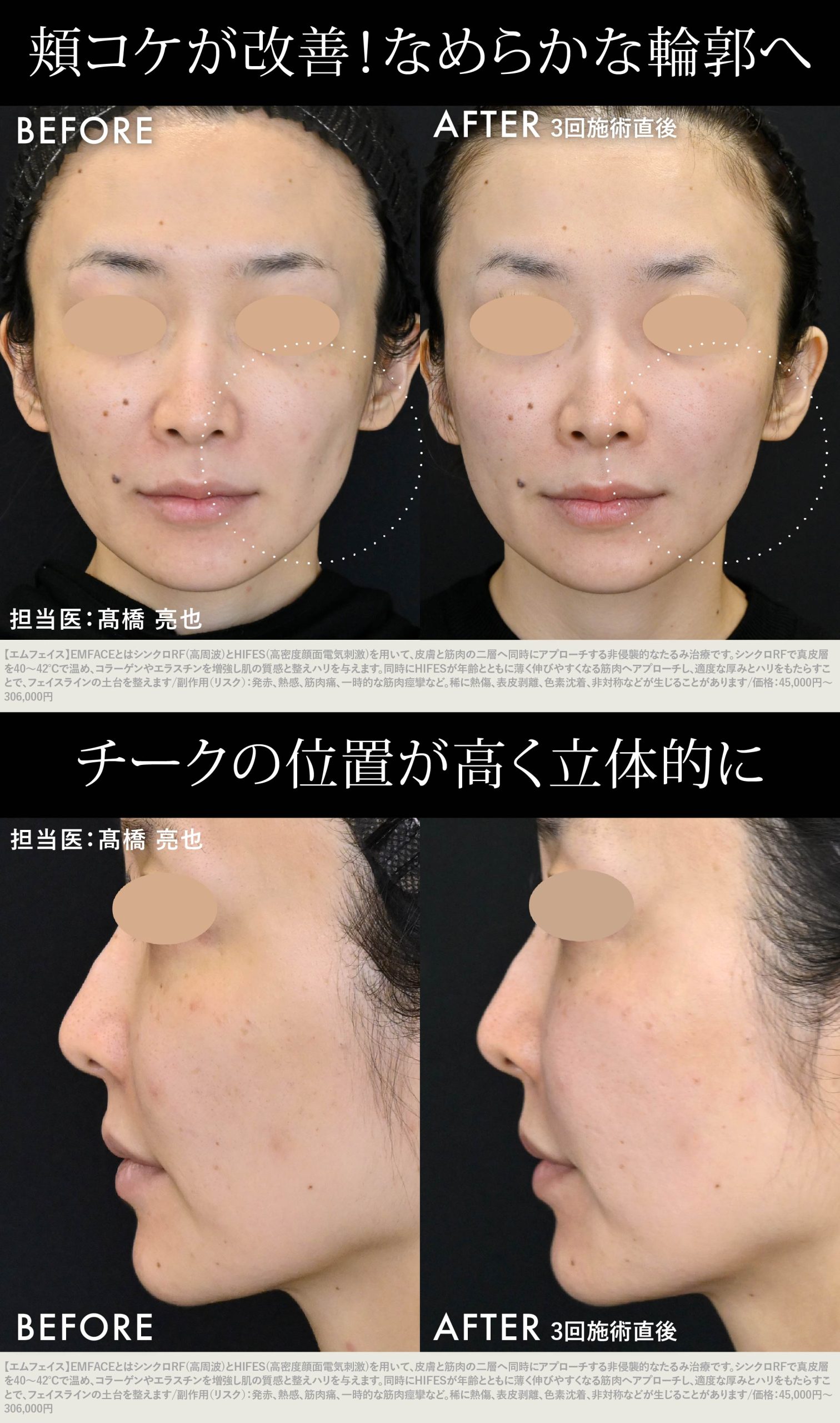 EMFACE症例写真