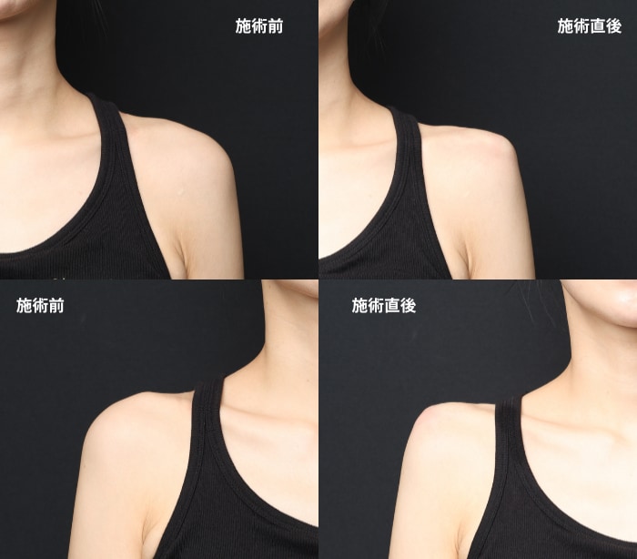 右8cc・左12cc｜左右差に合わせて注入量を変える
