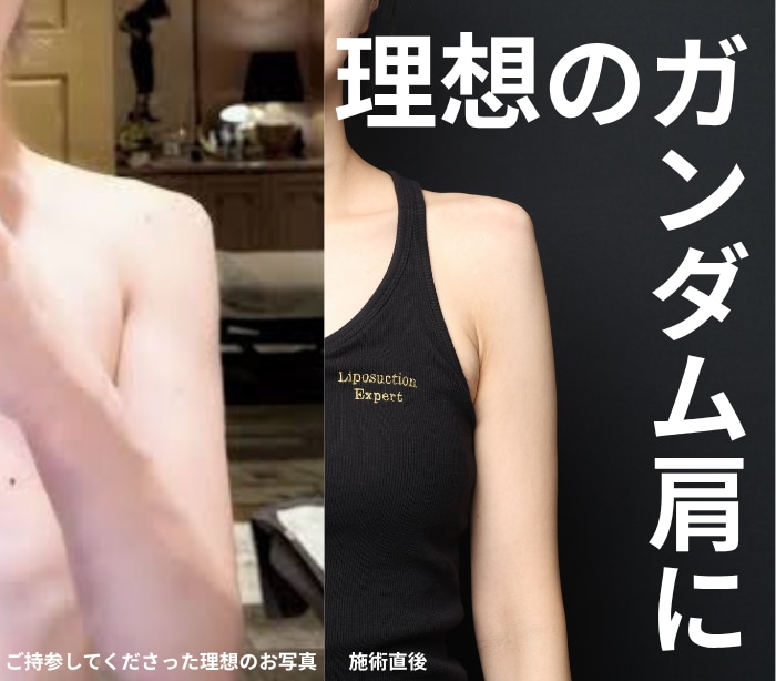 肩ヒアルロン酸20cc｜「ガンダムになりたい」を叶える強めの直角肩デザイン｜脂肪吸引エキスパートドクター小野聡真医師が直角肩について徹底解説