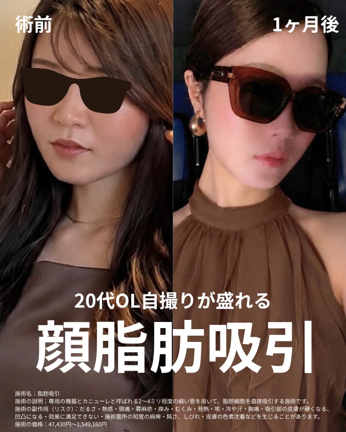 AIで理想の輪郭を事前設計｜SBCスタッフが脂肪吸引・名医 小野聡真を指名した顔脂肪吸引