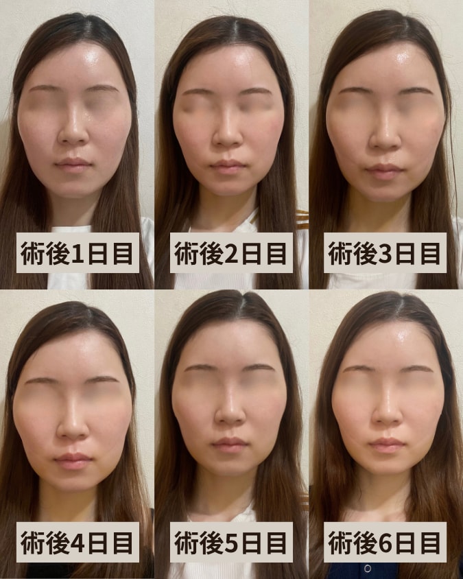 術後6日間のリアルな経過｜SBCスタッフだからこそ感じた「思ったよりダウンタイムが少ない」