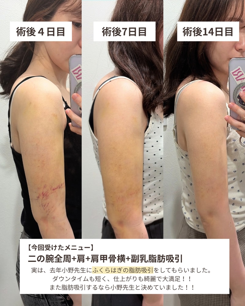 術後3か月｜「腕を出せるようになった」脂肪吸引の先にあった変化