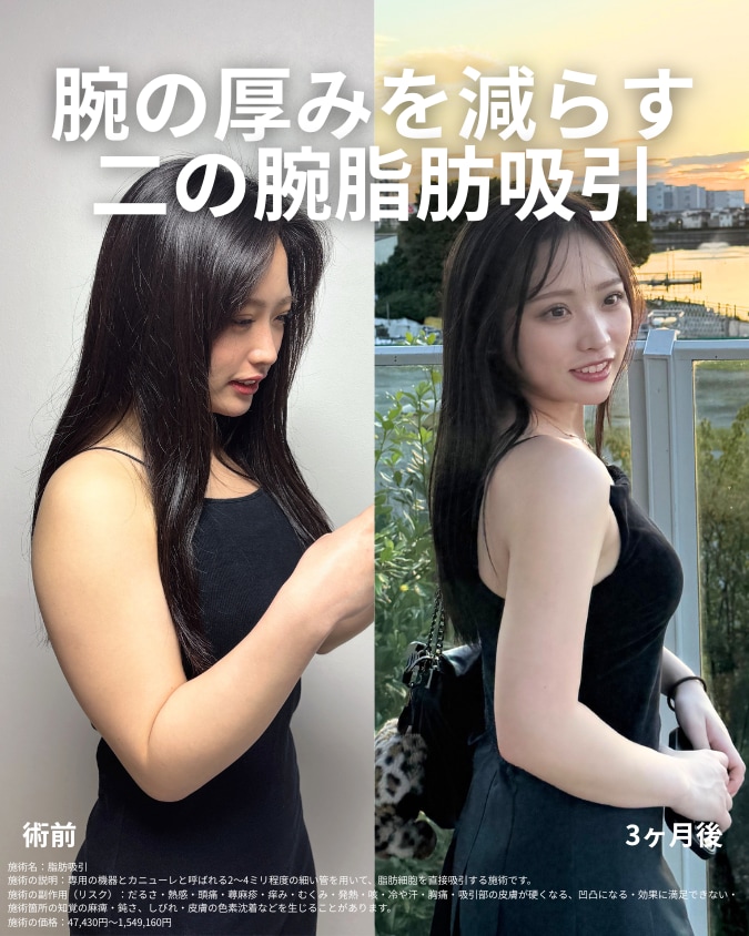 二の腕脂肪吸引とクォンタムRF併用｜SBCで一緒に働く看護師がベイザー認定医・小野聡真を指名　