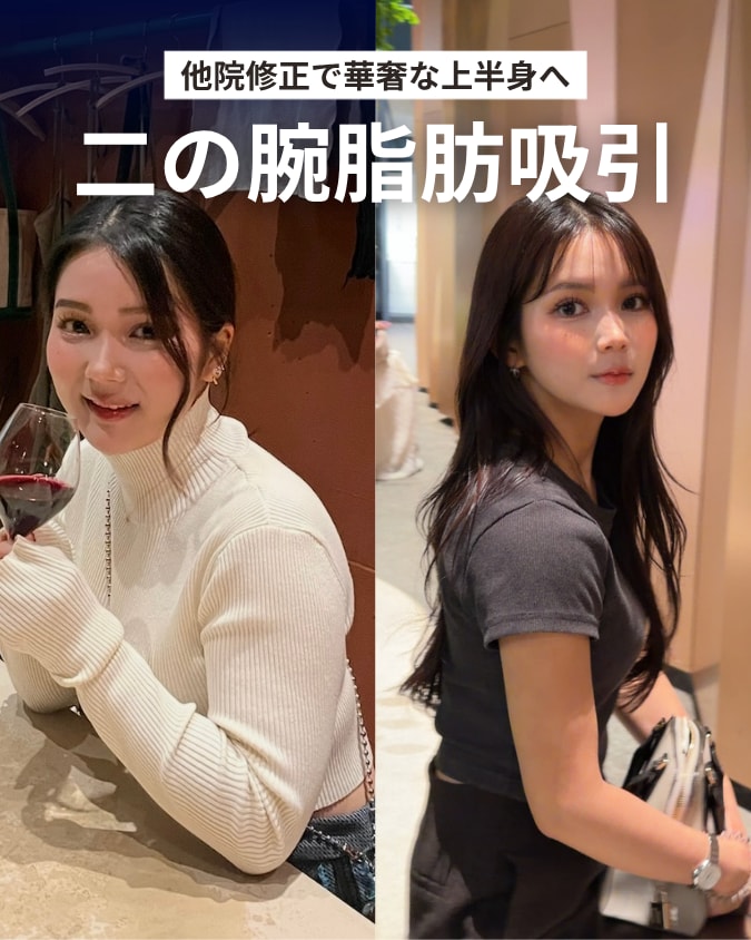 二の腕脂肪吸引の他院修正｜皮膚のたるみもクォンタムRFで治療した術後1ヶ月