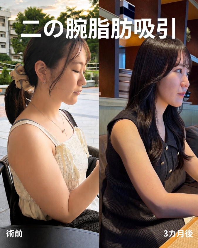 細ければ細いほどいい？二の腕脂肪吸引で「あえて脂肪を残す」　【脂肪吸引・名医】小野聡真医師が解説