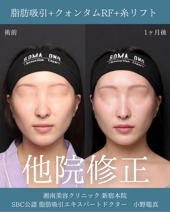 頬骨の張りと頬コケを脂肪吸引で改善｜他院修正の20歳女性症例を脂肪吸引の名医・小野聡真医師が解説