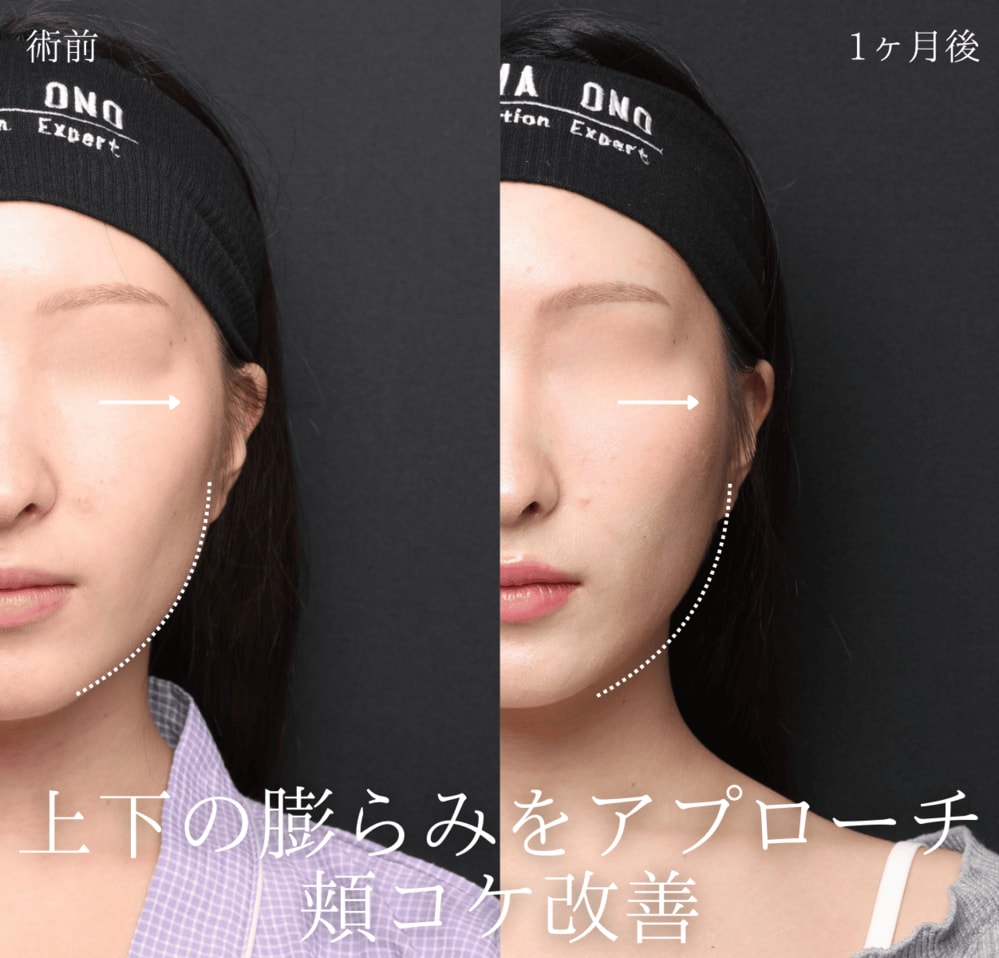 頬コケを目立たせているのは、凹みそのものではなく周囲との高低差かもしれない