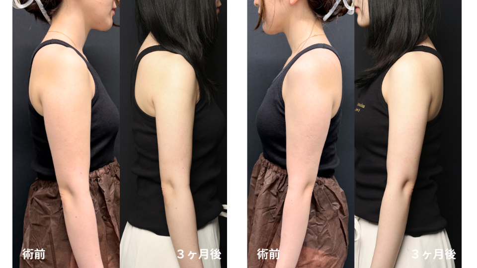 二の腕の脂肪を「あえて残す」。筋肉をオブラートのように包むデザイン