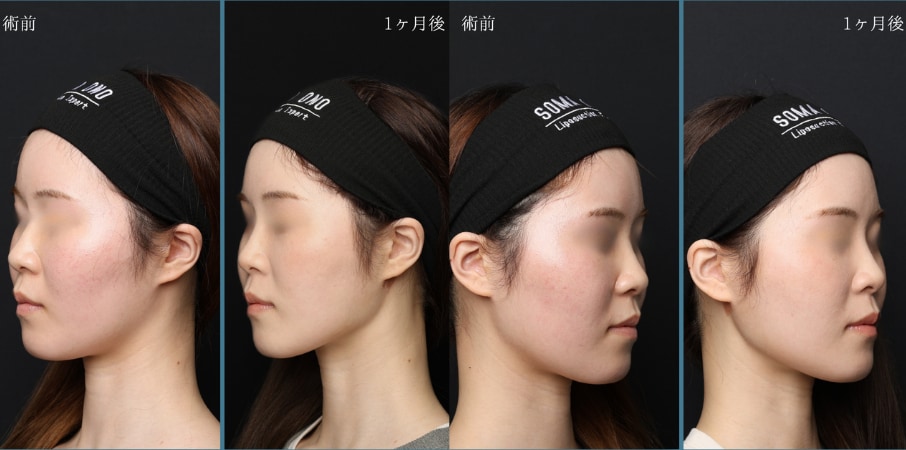 「脂肪吸引を任せるなら小野先生と決めていました」理想像をAIで準備してカウンセリングへ