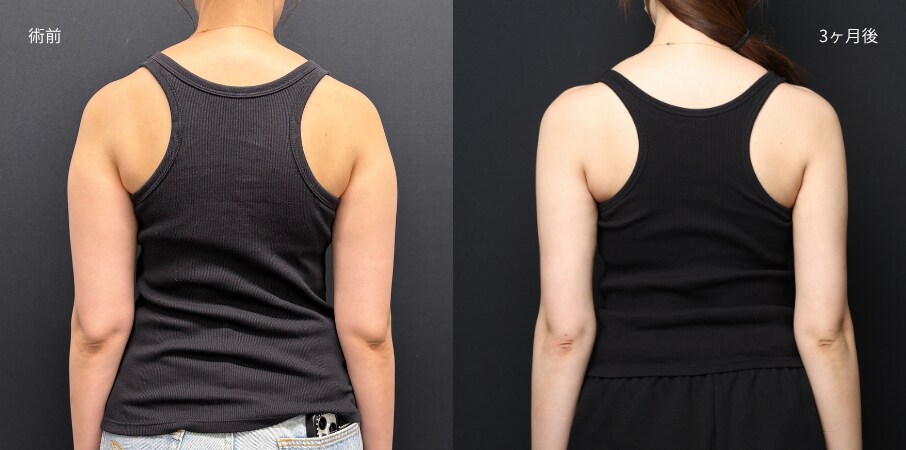二の腕脂肪吸引は肩・背中とのつながりまで考える