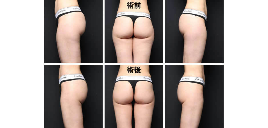 お尻の脂肪吸引で垂れない？丸みを残しながらひと回り小さくするデザイン