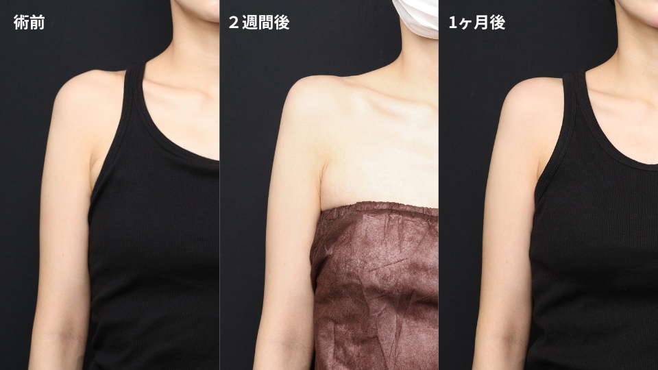 肩ヒアルロン酸20ccの1か月後|ガンダム肩の形は維持できる?実際の経過を脂肪吸引エキスパートドクター小野聡真医師が紹介