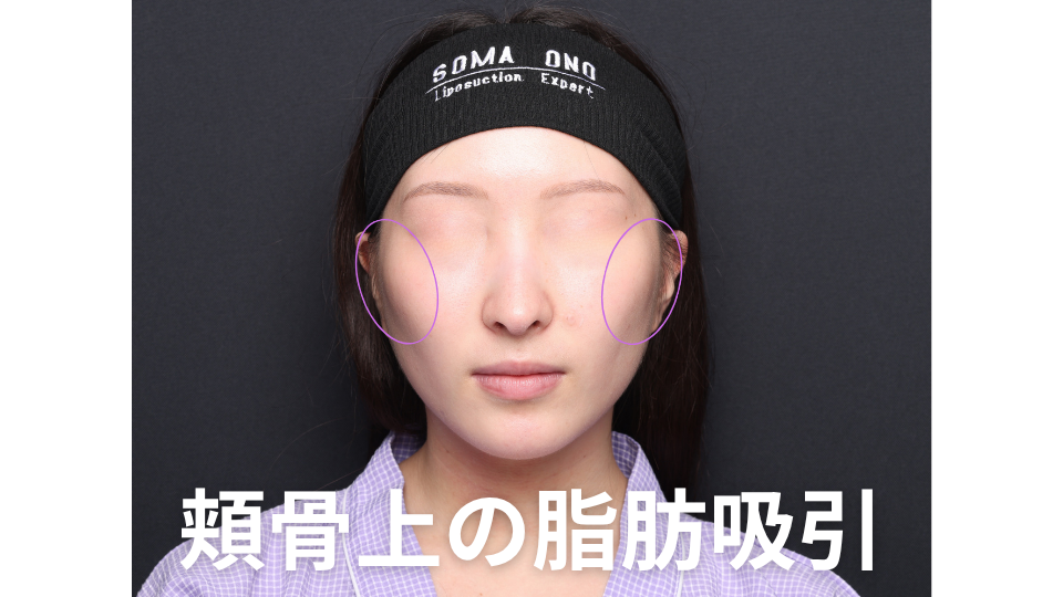顔の横幅は骨切りでしか変えられない？頬骨上脂肪吸引という選択肢