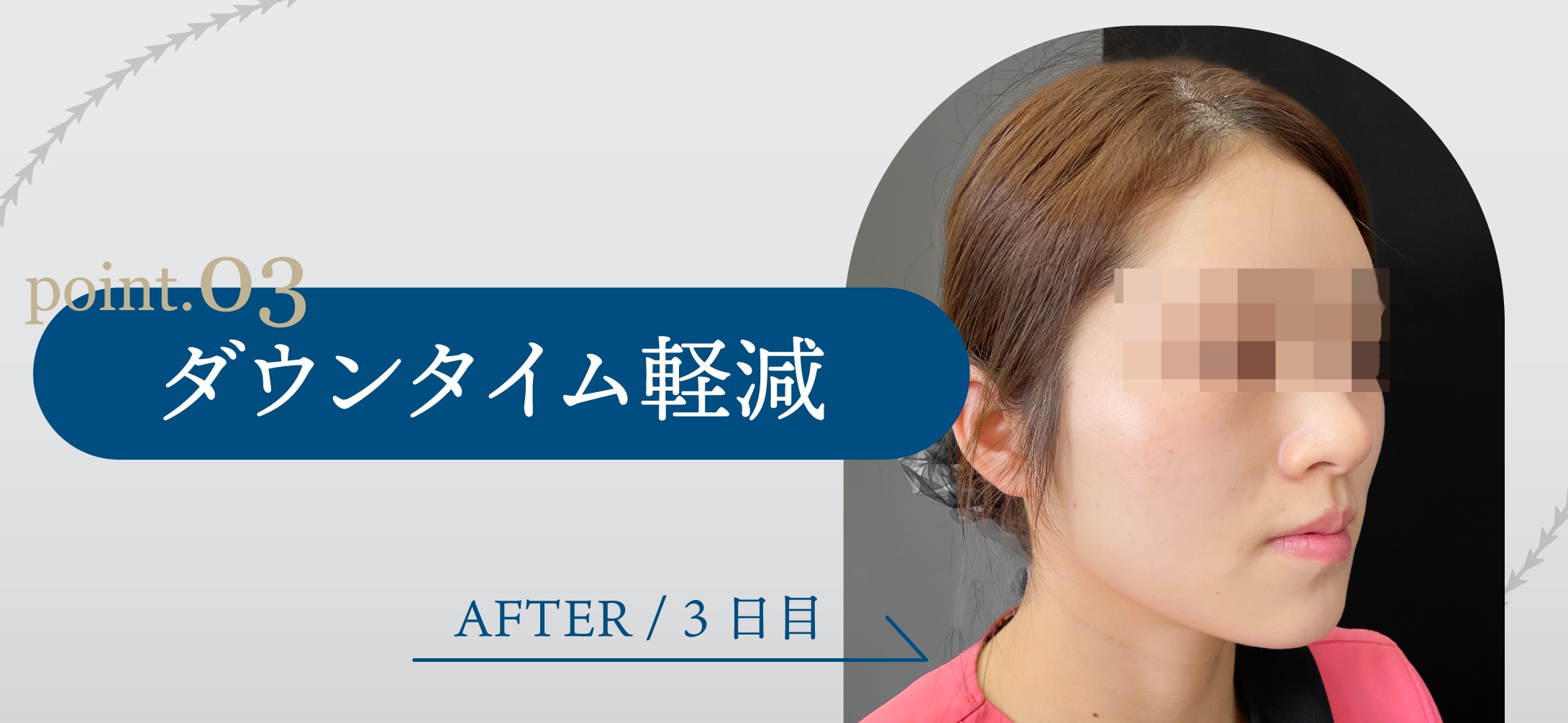 ダウンタイム軽減