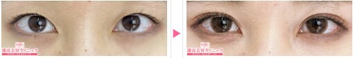 奥二重から大幅目力アップ！