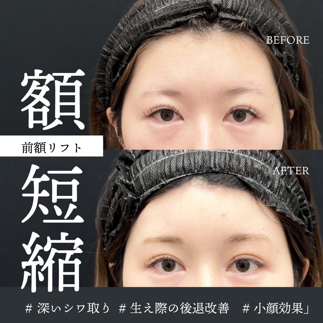 シワ改善・小顔・目元のたるみ改善|超長期的な改善治療