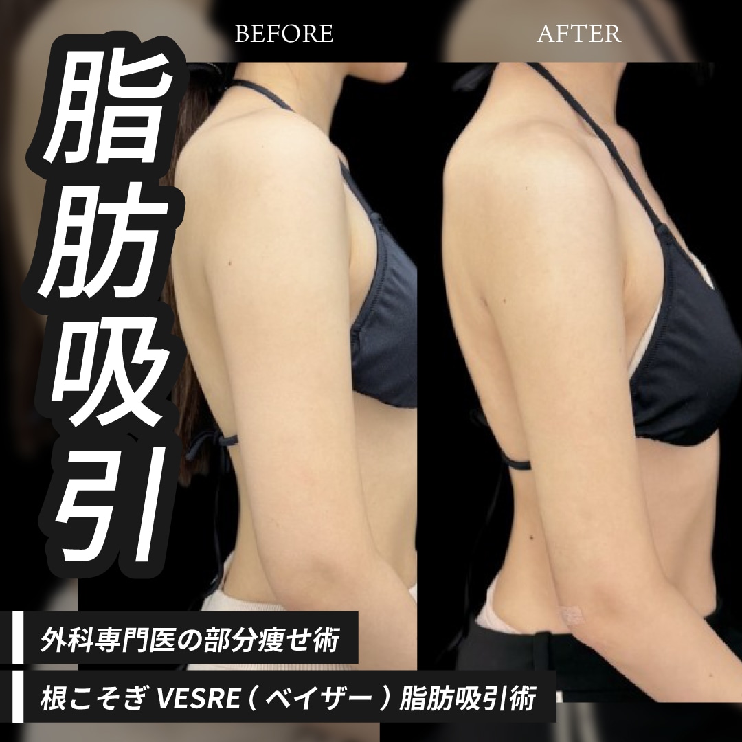 部分痩せ|脂肪吸引で理想のボディラインへ