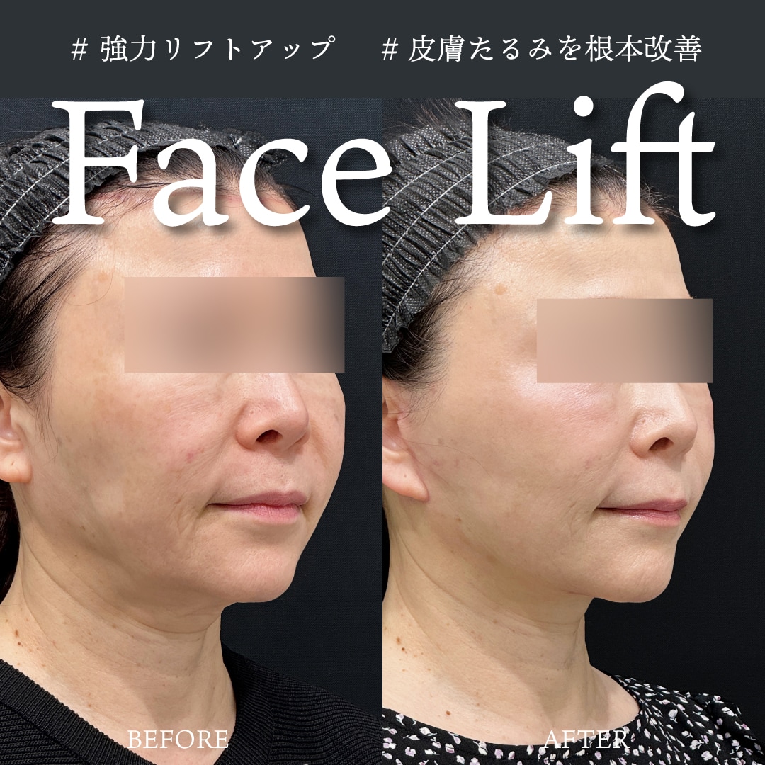 たるみ改善|筋膜から根本を引き上げる「切開リフト」