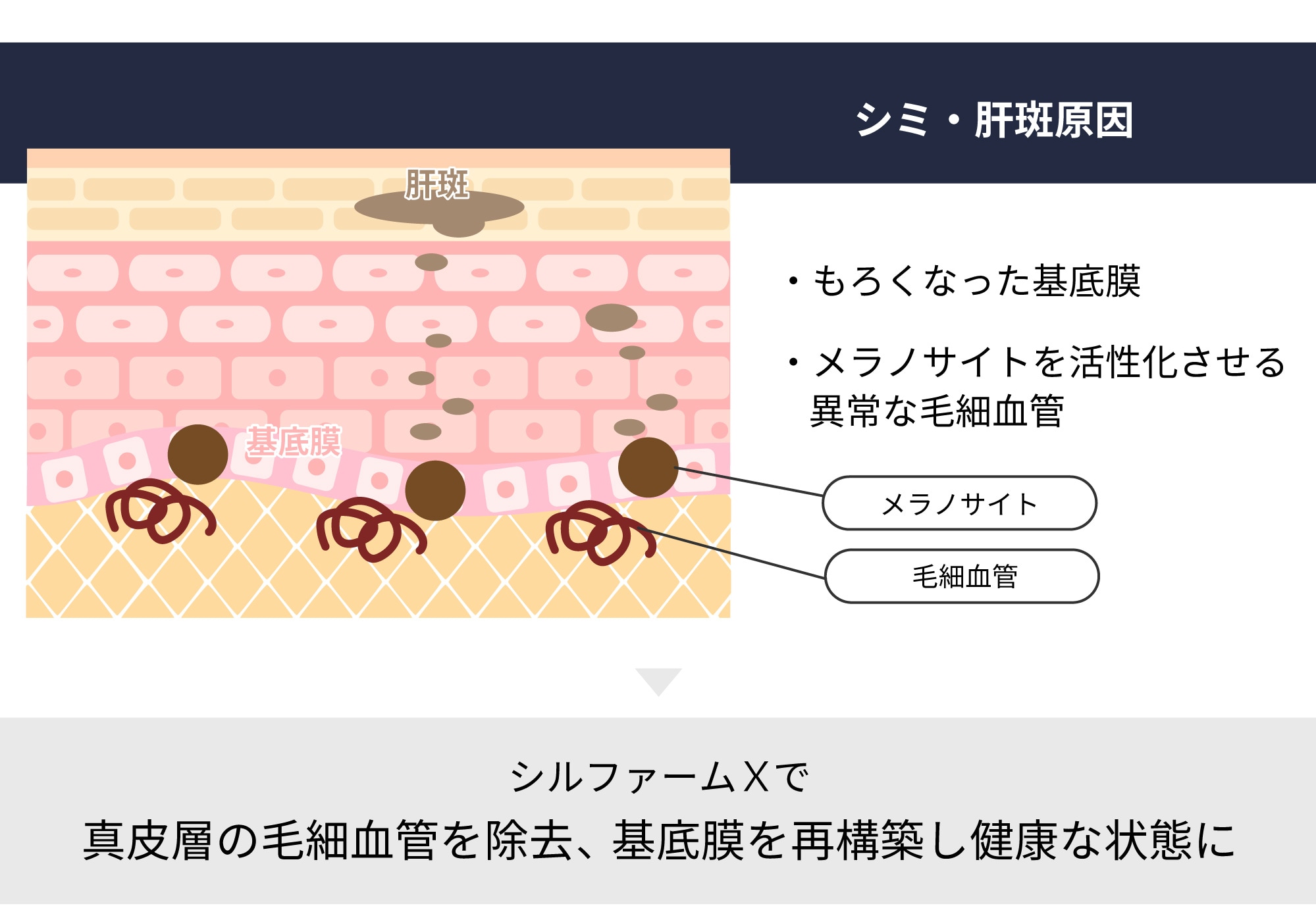 「肝斑治療の切り札」と言われる理由