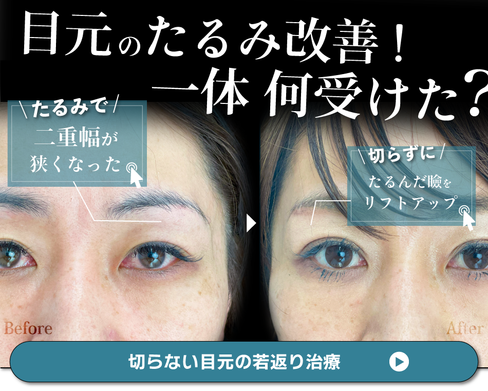 切らない目元の若返り治療5選｜まぶたのたるみ・目尻、目元の小じわは 