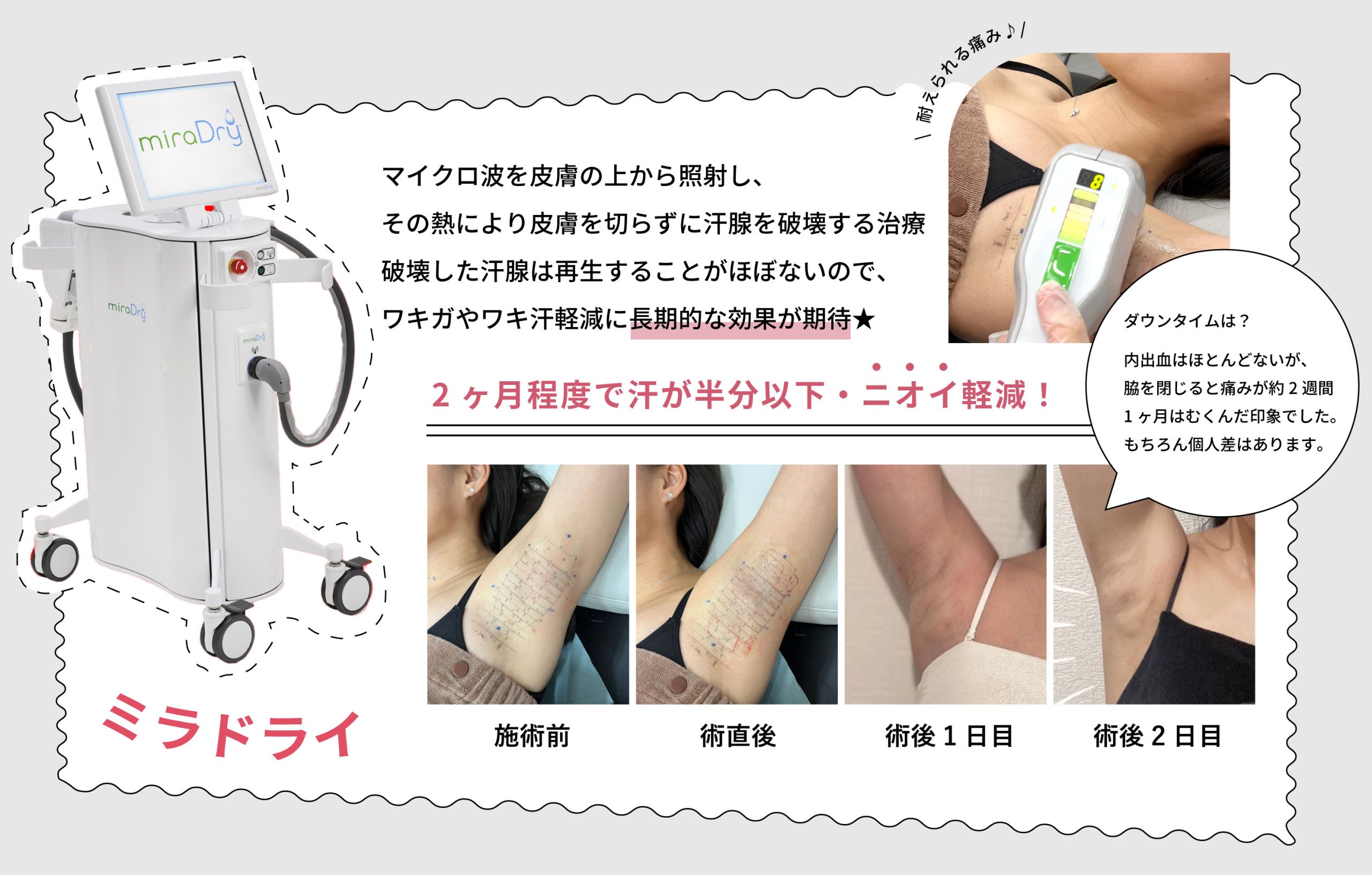 切らないワキガ・多汗症治療