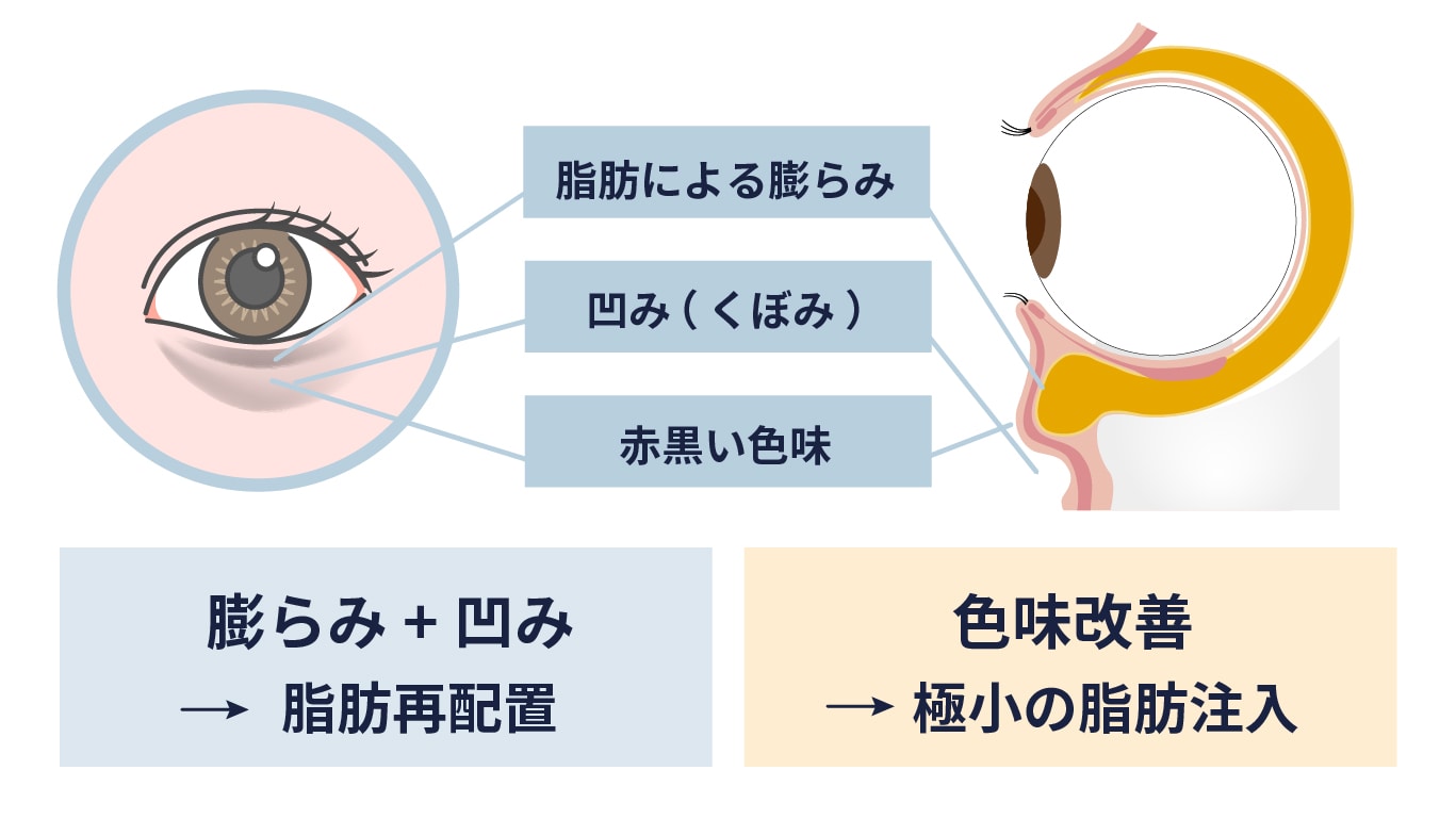 外科専門医によるこだわりの脂肪注入