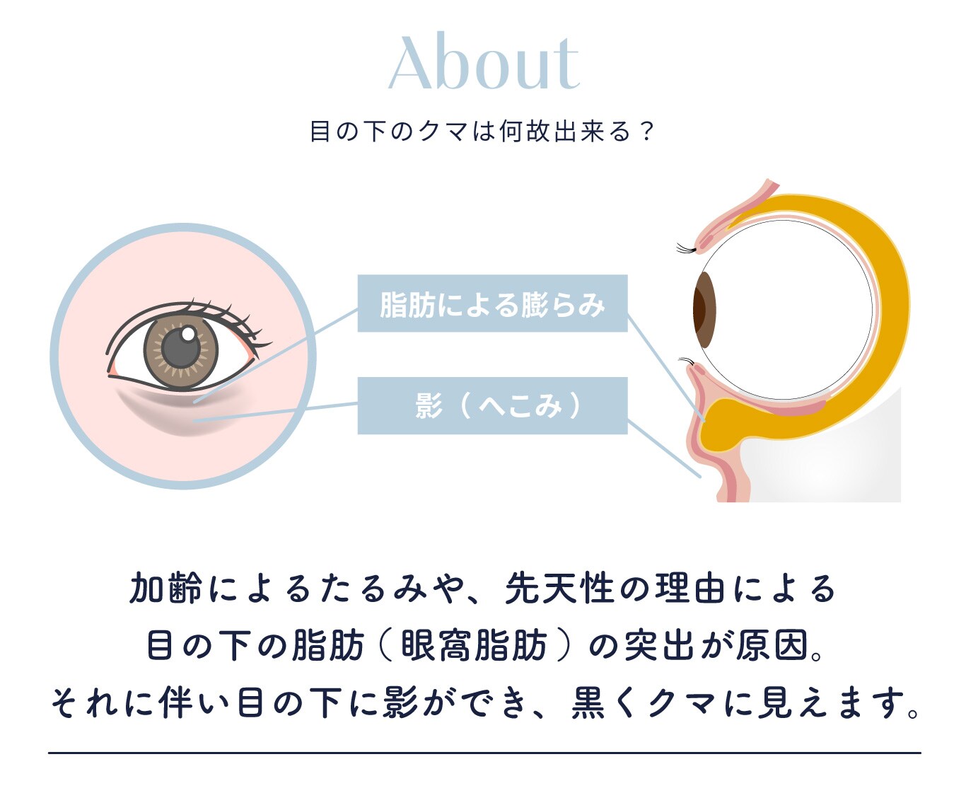 目の下の「眼窩脂肪」が原因