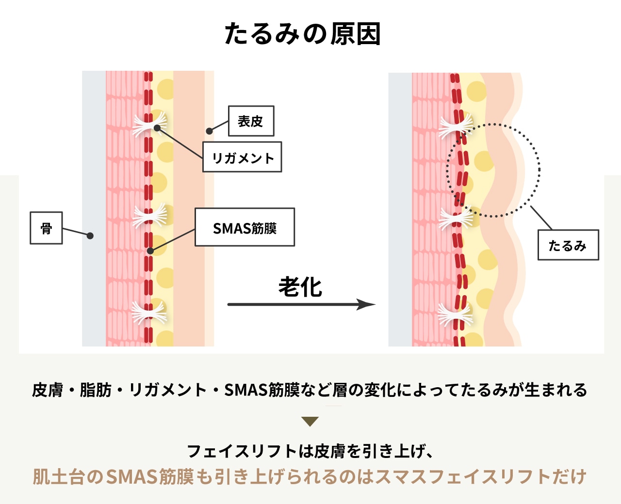 たるみの根本原因「SMAS筋膜」を引き上げる唯一の方法