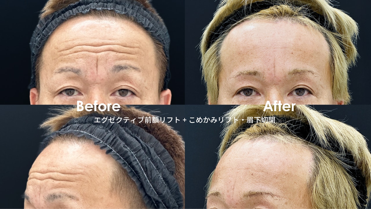 エグゼクティブ前額リフト・こめかみリフト