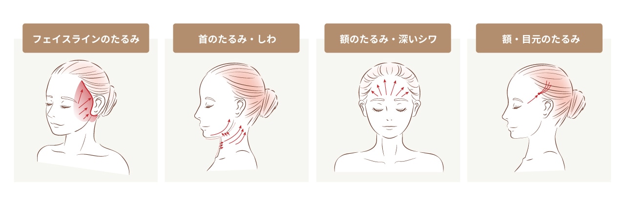 お悩みに合わせた５つのフェイスリフト