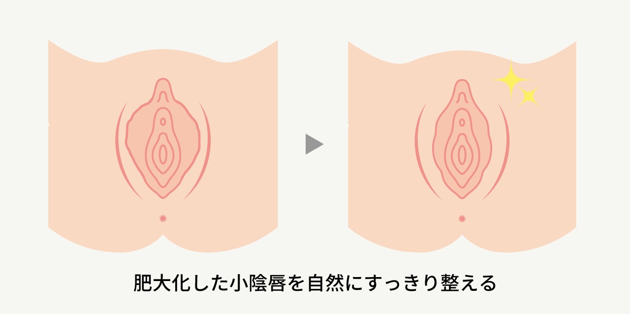 小陰唇縮小術