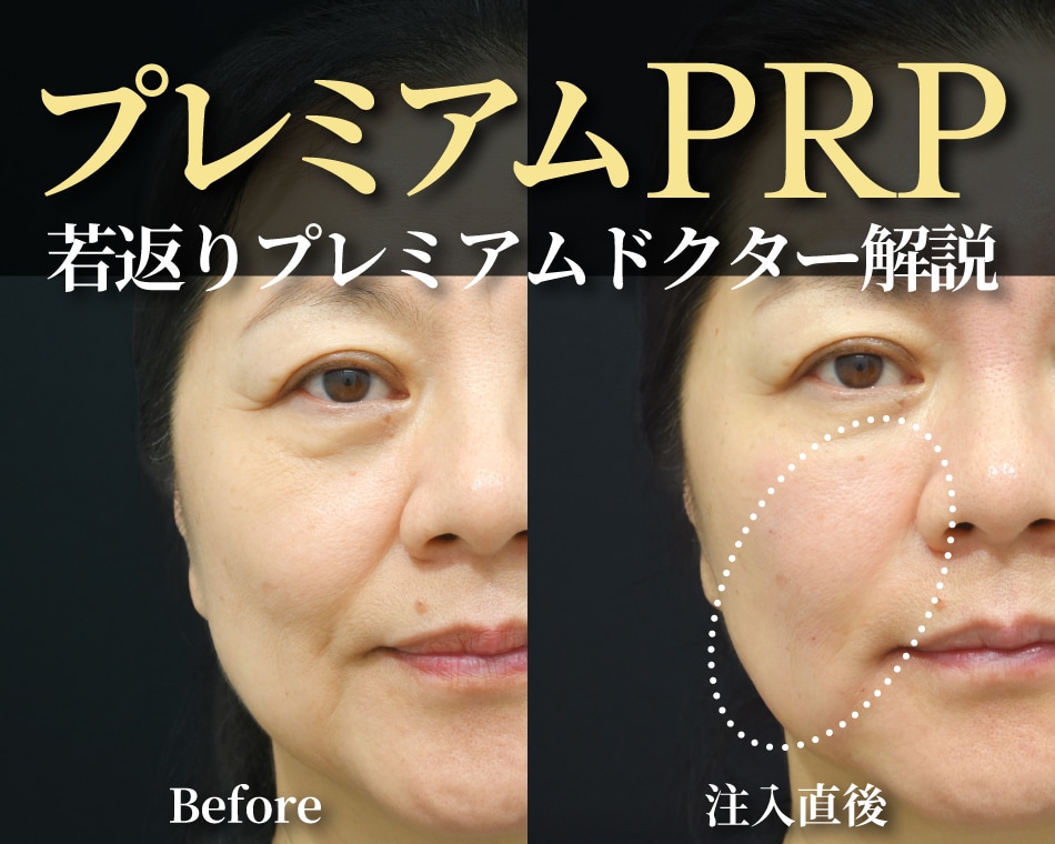 PRP療法って効果ない?リスクやデメリット何でもお答えします!