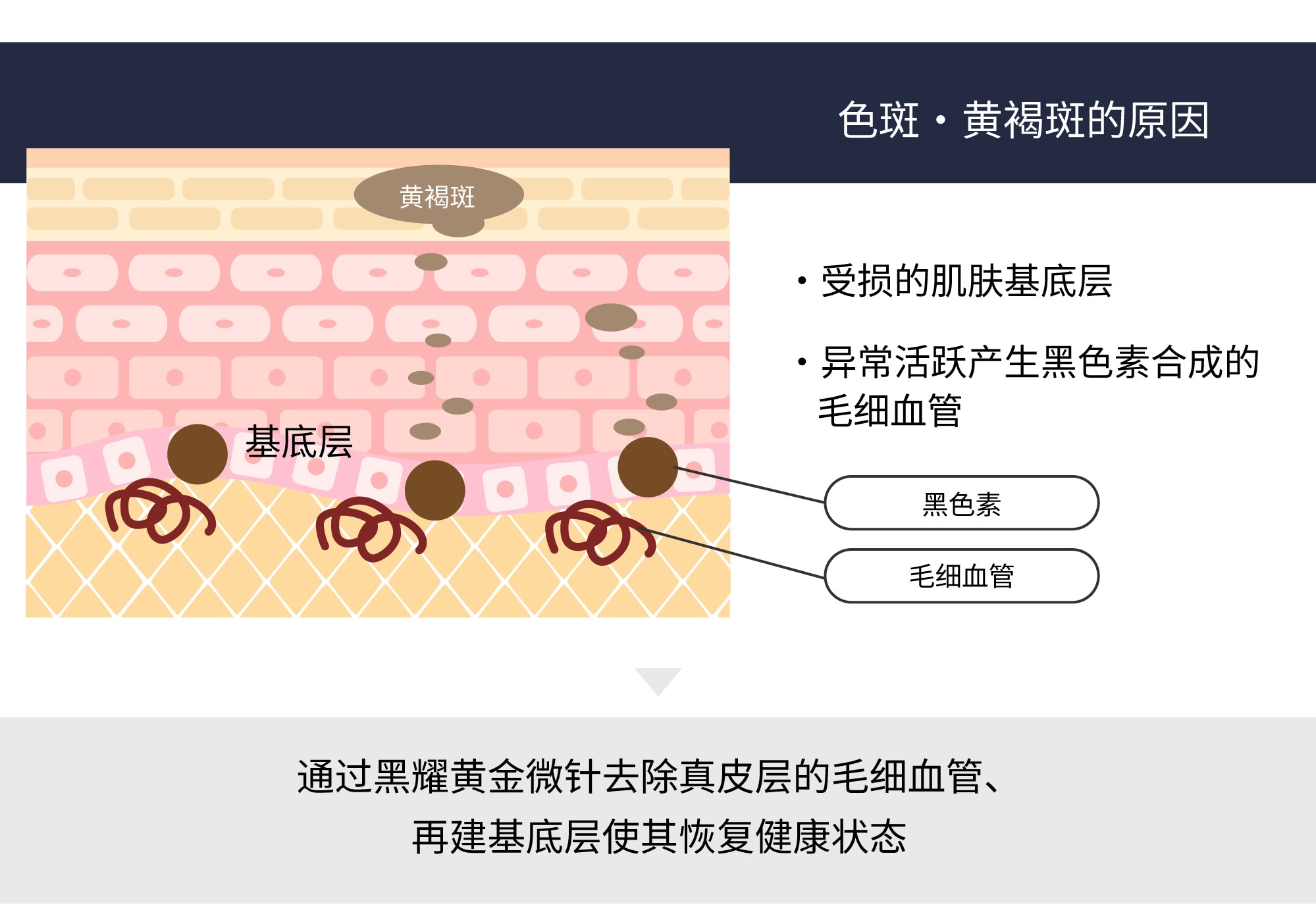 被称为「肝斑治疗的王牌」的理由
